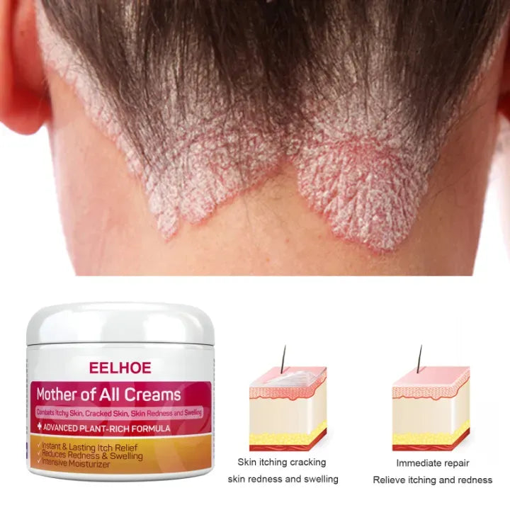 Skin Psoriasis Cream