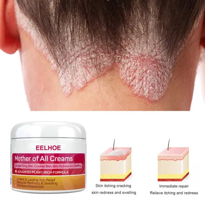 Skin Psoriasis Cream