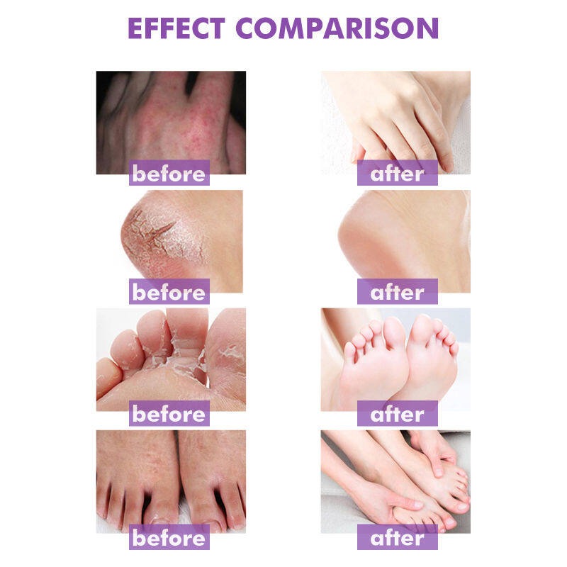 Skin Psoriasis Cream